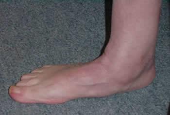 Podologische/zooltjes voor voet/enkel klachten Voor voet en/of enkel klachten. Klacht en/of blessure aan de voeten of enkels zijn erg vervelend en kunnen de bewegingsvrijheid ernstig beperken.