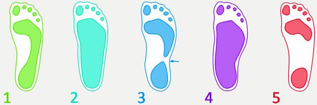 Podologische/zooltjes voor pes/planus/valgus voeten (platvoeten) Er zijn twee soorten platvoeten n.l. De soepele platvoeten en de starre/stijve platvoeten.