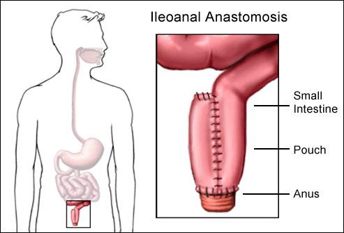 De pouch wordt gemaakt van het laatste stuk dunne darm en wordt aan de anus verbonden. De ingreep wordt vaak via een kijkoperatie (laparoscopisch) gedaan.