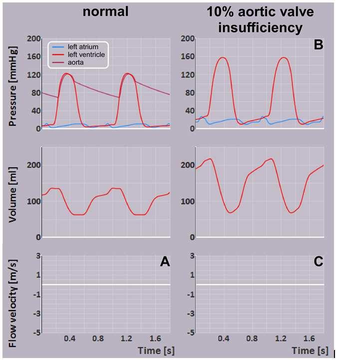 answer questions 3 and 4 on a separate page 3. The figure below shows some hemodynamic signals of a normal healthy heart and of a heart with acute aortic insufficiency of 10% (i.e., the leakage area is 10% of the valves normal opening area).