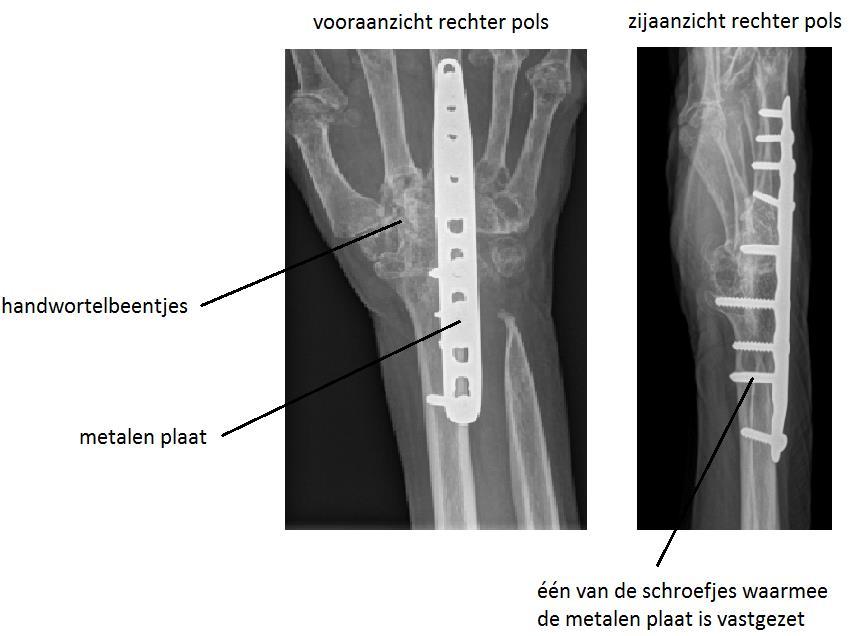 Om het polsgewricht vast te zetten wordt gebruik gemaakt van een metalen plaat en schroefjes (zie afbeelding 2). Hiermee wordt het spaakbeen (radius) aan de middenhandsbeentjes bevestigd.