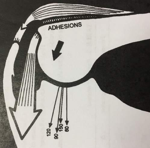 deltoide adhesies tenodese effect deltoid compressie GH,