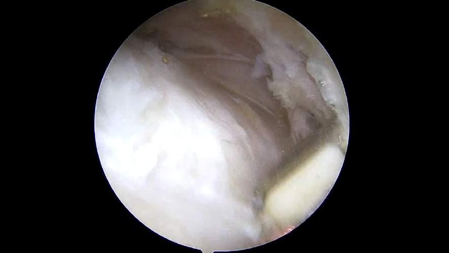 13 ** Arthroscopy. 1996 Aug;12(4):457-61.