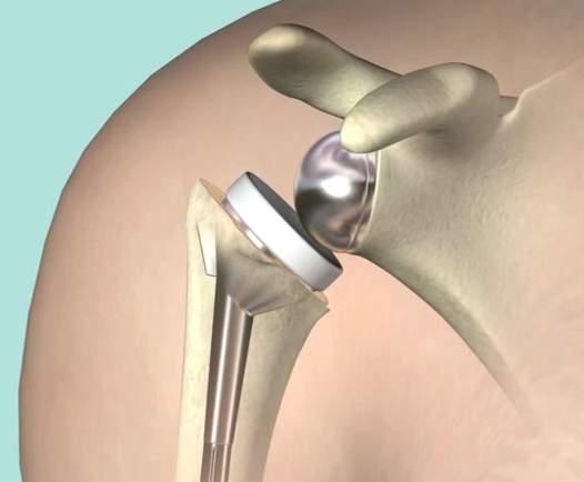 . vertraagde beenderige heling indien refixatie fractuur fragmenten op breuk minder frequent bij geplande prothese