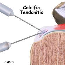 1. Stijfheid bij onderliggende calcifiërende tendinitis