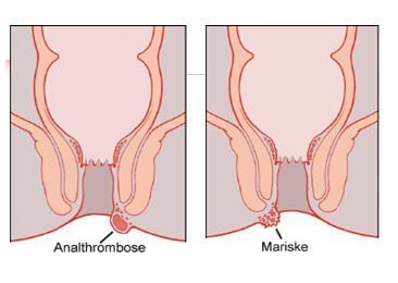 Getromboseerde aambei Zwelling BUITEN/rand anus Stolsel in onderhuids adertje (thrombus