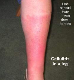 Cellullitis - Erysipelas Wondje Kweek?