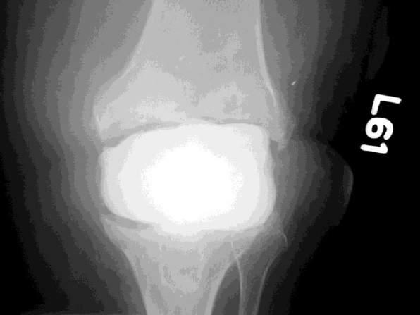 Chronische infectie: Revisie in 2 tijden Prothese verwijderen Debridement (Treat