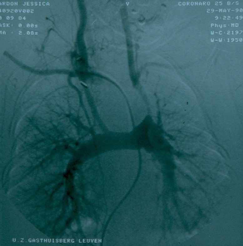 Malposities - single ventricles Onmiddellijke