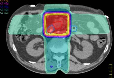 PREOPANC radiotherapie vs