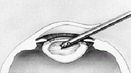 Via dit sneetje wordt het lenskapsel aan de voorzijde geopend, waarna met speciale apparatuur de troebele lens wordt verwijderd.