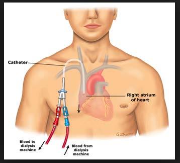 (Afbeelding 2: Getunnelde catheter) Indien de aanleg van een fistel of het plaatsen van een dialysecatheter wordt gepland
