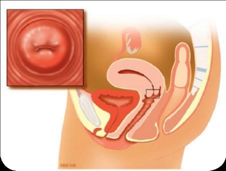 De gynaecoloog draait vervolgens een borsteltje rond in de baarmoedermond, en verwijdert zo wat oppervlakkige cellen.