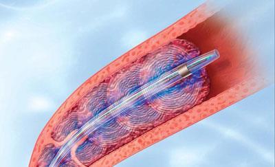 Nieuwe ontwikkelingen 1 RCT in 59 patiënten stabiele patiënten met RV disfunctie: ultrasound assisted catheter-directed