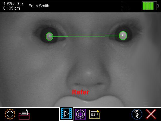 a smartphone photoscreening app to detect refractive amblyopia risk factors in
