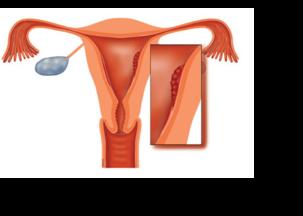 Baarmoederkanker Informatie over de behandeling van baarmoederkanker. Baarmoederkanker is een kwaadaardige aandoening van het slijmvlies van de baarmoederholte.