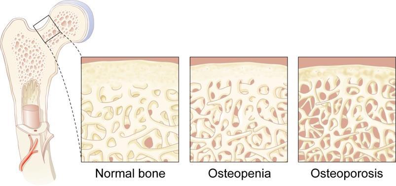 Definitie van osteoporose Osteoporose is een skeletaandoening die zich kenmerkt door een lage botmineraaldichtheid (botmassa) en een verstoorde
