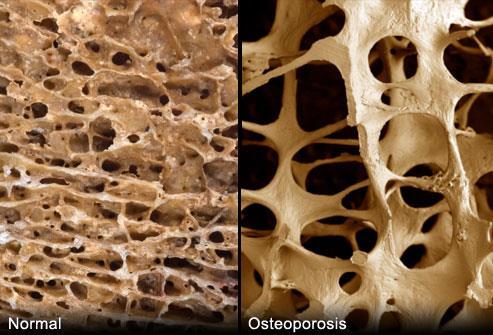 osteoporose en fractuurpreventie Thuisarts: botbreuken en
