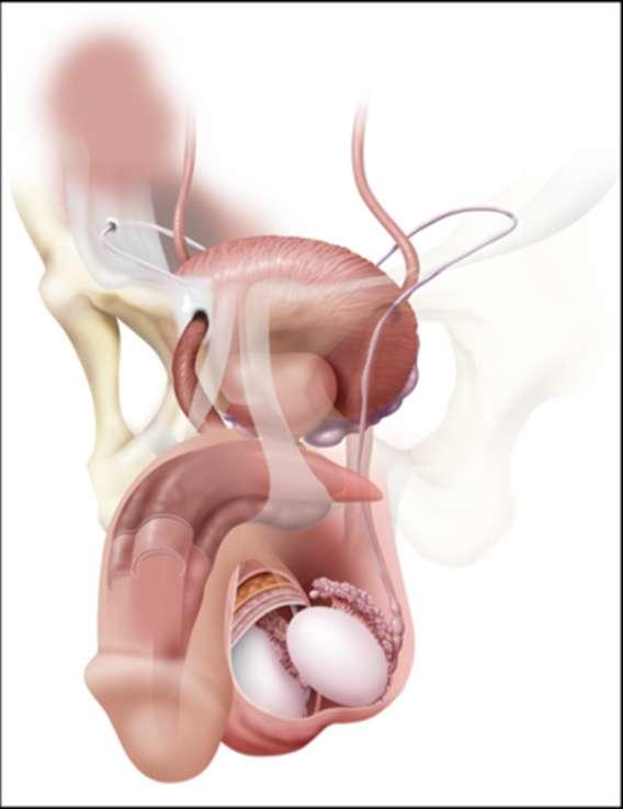 Male Sling De AdVance Male Sling (AMS): polypropyleen monofilament mesh die retrourethraal geplaatst