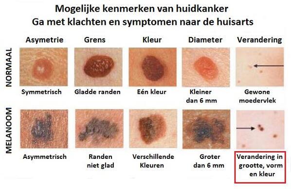 1.2 Melanoomkanker De meeste vormen (90%) van huidkanker zijn goed te genezen, behoudens zg. melanomen. Melanomen zijn pigmentvlekken en zien er uit als moedervlekken.