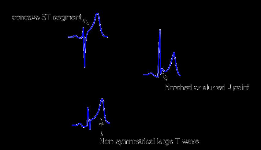 Vroege Repolarisatie Zeer frequente bevinding Smiley configuratie Overigens gezonde asymptomatische jonge volwassene Met name V1-V3