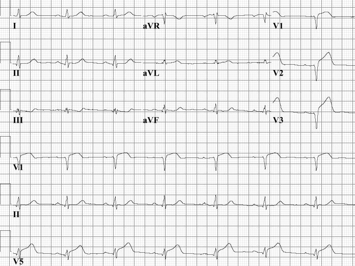 Maak uw keuze... 1. Vroege repolarisatie 2. Onderwandinfarct 3. Voorwandinfarct 4. Pericarditis 5.