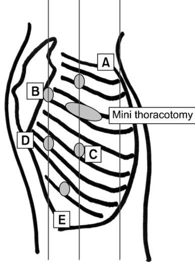 Thoracale fase: mobiliseren oesofagus en lymfeklier dissectie thoracaal.