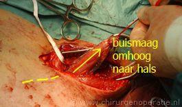 3. Transhiatale slokdarmresectie met cervicale anastomose 1. Abdominale fase: volledig mobiliseren maag en distale oesofagus, lymfeklier dissectie. 2.