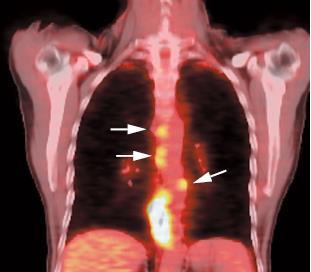 Diagnostiek: - Lokale stadiering: CT-thorax -