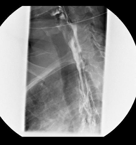 Diagnostiek naadlekkage CT-thorax Stellen van diagnose Collectie locaties Drainage