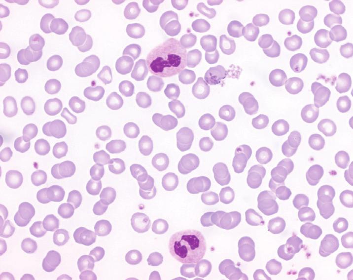 Erfelijk( geslachtsgekoppeld) Bloed: Poikilocytose / microcytose Hypochroom Beenmerg: sideroblasten Congenitale