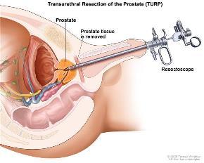 TURP Langetermijn complicaties: - Retrograde ejaculatie (> 70%) - Impotentie (3-32%/14%) - Partiele incontinentie (6%) - Totale incontinentie (1%)