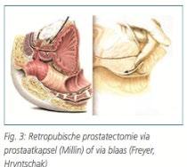 Open Prostatectomie Bij volumes > 80-100ml Enucleatie van prostaatadenoom met indexvinger Symptomatische verbetering in