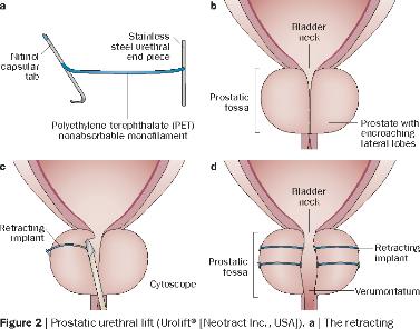 Prostatic Urethral Lift (PUL) Compressie van de laterale lobben door cystoscopisch inbrengen van kleine permanente implanten. Verbetering van klachten, Qmax en QoL Maar inferieur aan TURP.