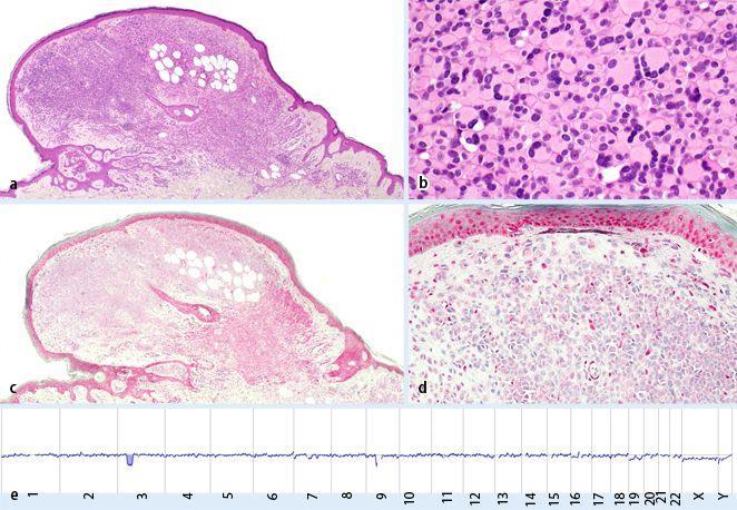 Wat zijn de kenmerken van een BIMN/T -Typisch vooral dermale tumor -Polypoid contour -Grote epithelioide cellen en deels een kleine nevoide component -deels lymfocytair infiltraat/tumor infiltrerende