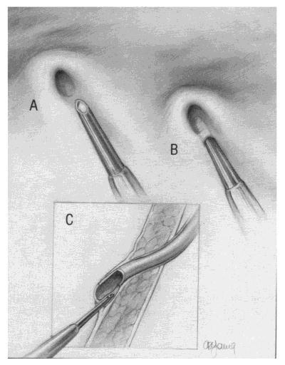 Laparoscopie en operaties via een pneumovesicum Een ureterreïmplantatie kan via een laparoscoop worden verricht.