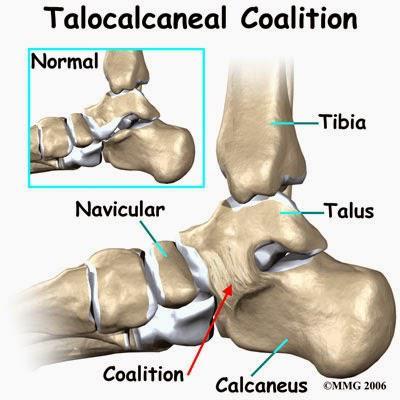 Tarsale coalitie Congenitale abnormale verbinding tussen voetwortelbeenderen.