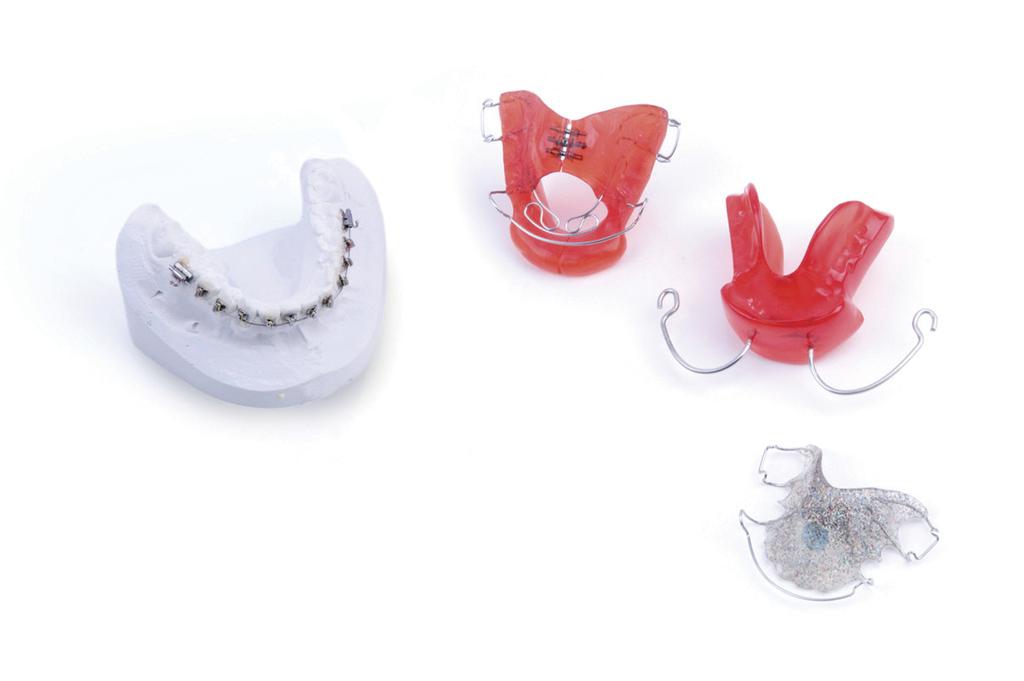 Afhankelijk of de tanden moeten worden rechtgezet (vaste beugel als de tanden gewisseld zijn) of de vorm van de kaak moet worden aangepast (uitneembare beugel vóórdat een kind wisselt, omdat de kaak