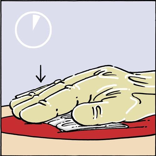 3. Evaluatie van de therapeutische waarde en het belang van de specialiteit 1 De initiële registratie in 2004 was gebaseerd op het hemostatisch effect van TACHOSIL versus oudere presentaties