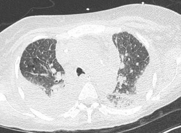 Marie, stamceltx bij myelofibrose BAL kweek negatief virale PCR negatief