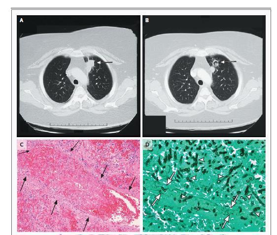 als de tijd het toe laat aspergillus op de IC hoog risico intermediair laag risico neutropenie hematolog.