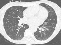 epicrise Marie, stamceltx bij myelofibrose Maartje, chemotherapie bij NHL werkdiagnose: aspergillus pneumonie na 10 dg uit dip na 17 dg gedetubeerd delier en zwak pulmonaal hersteld na 5 weken naar