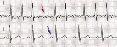 INFOBROCHURE IICardioversie Oorzaken van onregelmatig hartritme 7 Veel voorkomende klachten van een onregelmatig hartritme zijn: duizeligheid, syncope (flauwvallen), hartkloppingen en kortademigheid.