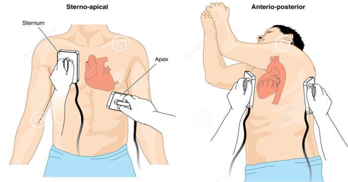 5.4 Cardioversie in de praktijk De cardioversie gebeurt meestal door de paddles of pads van de defibrillator aan te brengen ter hoogte van het sternum, dus onder de clavicula (rechts), en apicaal