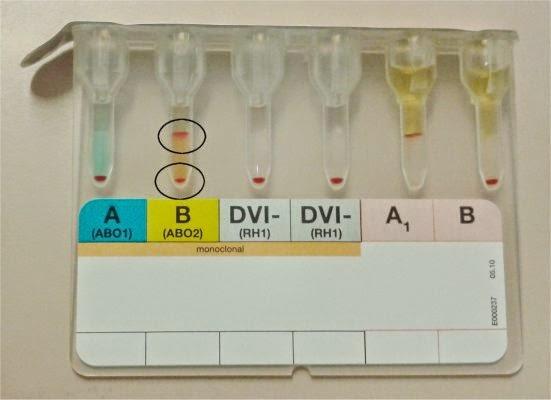 Mixed-field reacties Verklaringen mixed-field: - Recente transfusie (rechts: Oneg bloed bij Bneg ontvanger) - Allogene stamceltransplantatie bij