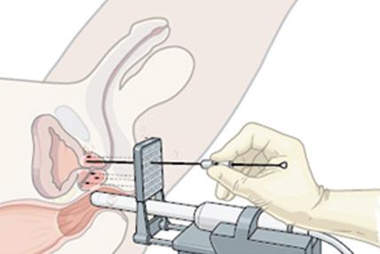 De operatie Letterlijk vertaald betekent brachytherapie: therapie van dichtbij.
