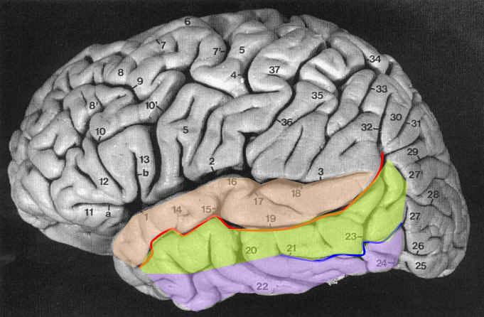 Semantische dementie (progressieve vloeiende afasie) - Stoornis in semantisch geheugen (10 25%) -Verbale en non-verbale