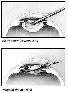 De operatie Om de operatie te kunnen uitvoeren wordt er 1 uur voor de ingreep een pilletje in het oog aangebracht om de pupil open te zetten. Tegenwoordig gebeurt de ingreep onder lokale verdoving.