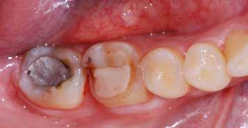 LT-D2 Lage transparantie (LT-IQ) LT-A LT-B LT-C LT-D Medium opaciteit (MO) MO-0 MO-1 MO-2 Van