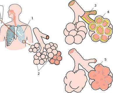 COPD COPD: Chronic Obstructive Pulmonary Disease verzamelnaam voor longziekten: Chronische bronchitis en Longemfyseem constant ademhalen